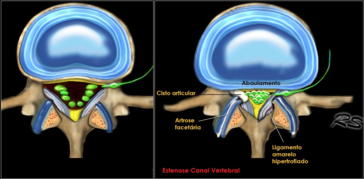 disco_estenosis.jpg